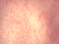 Measles (Associated Press)