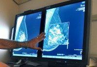 Mammography