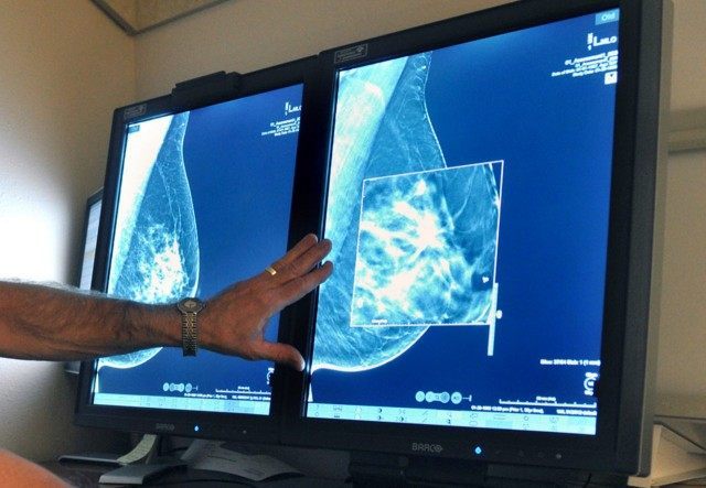 Mammography