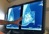 Mammography