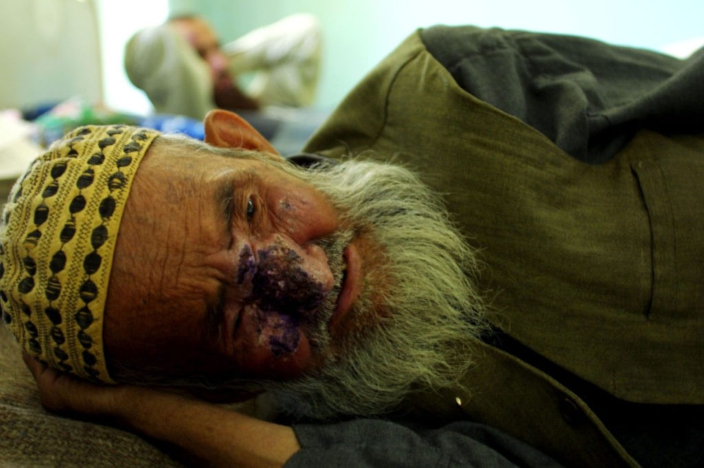 405087 03: A Man Suffering From Cutaneous Leishmaniasis, A Disfiguring And Disabling Skin Disease, Lies In A Hospital Bed After Receiving An Injection May 8, 2002 In Kabul, Afghanistan. Leishmaniasis Is Caused By A Parasite Transmitted By The Sandfly. The Disease Has Affected Approximately 100,000 People In The Capital City This Year. The Disease, Which Begins With A Lesion On The Area That Has Been Bitten, Is Linked To Poor Social Conditions, Especially Lack Of Hygiene And Poor Removal Of Waste Material. Some Estimates Say That Fifty Percent Of Afghans Suffer From The Disease. (Photo By Natalie Behring-Chisholm/Getty Images)