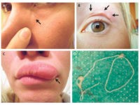 woman-documents-parasite-under-skin-New-England-Journal-of-Medicine Woman Documents Moving Lump on Face with Selfies, Doctors Find Parasite
