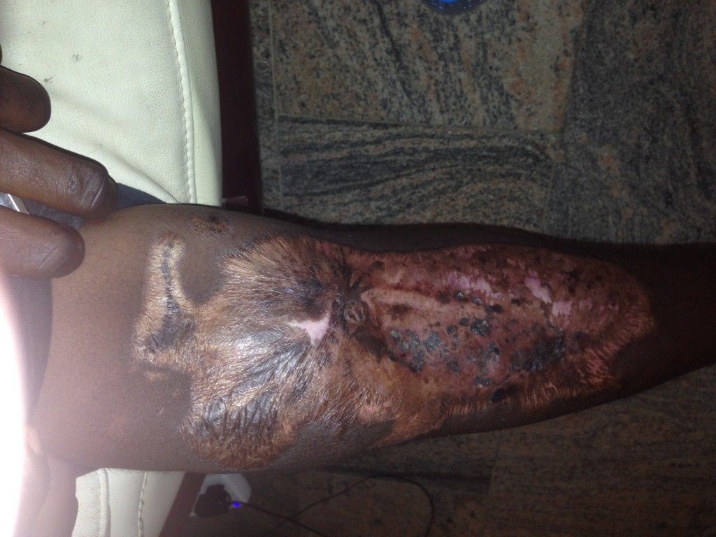 "Henry," a Nigerian Christian boy abducted by Boko Haram, shows off his irreparable leg injury.