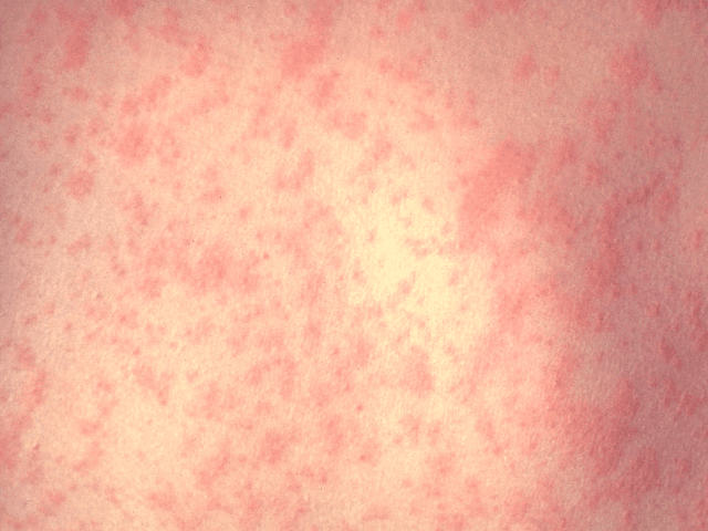 Measles (Associated Press)