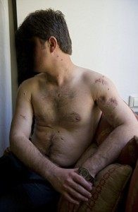 Rafi Hottak torture injuries