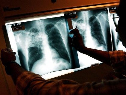Healthcare Workers Fight TB In The Inner City