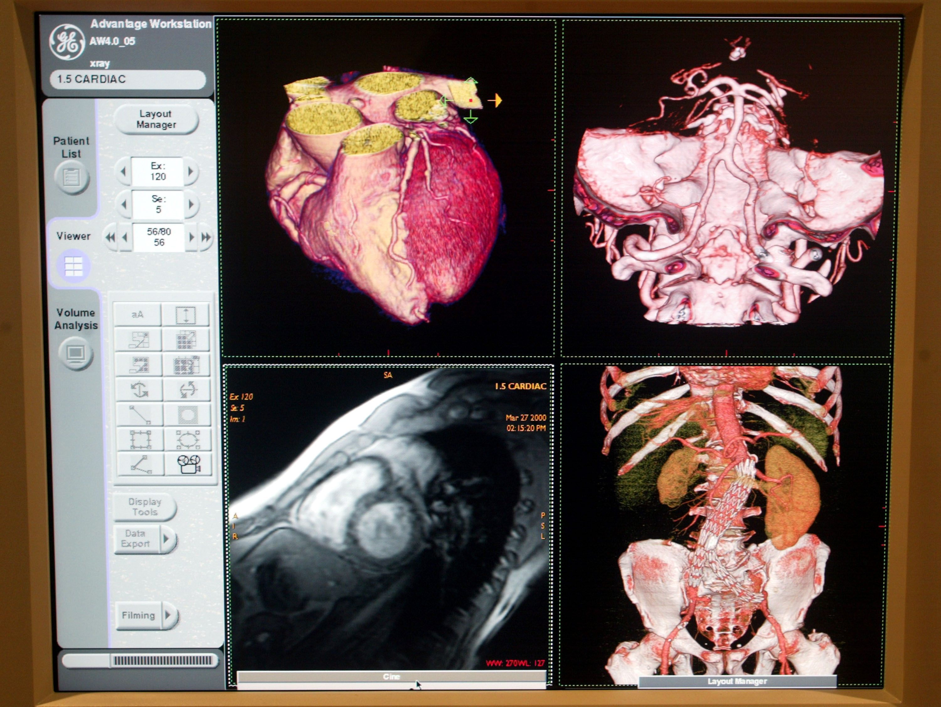 Planned Parenthood's Organ Harvest Exposed as Profit by... Media Matters