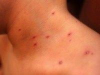 Child with Chickenpox Child with Chickenpox