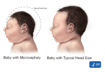 Photo compares a normal sized head to one with microcephaly.