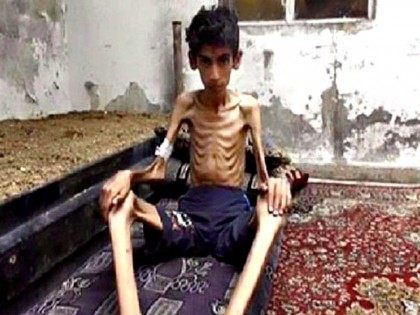 starving_boy_in_Madaya AP