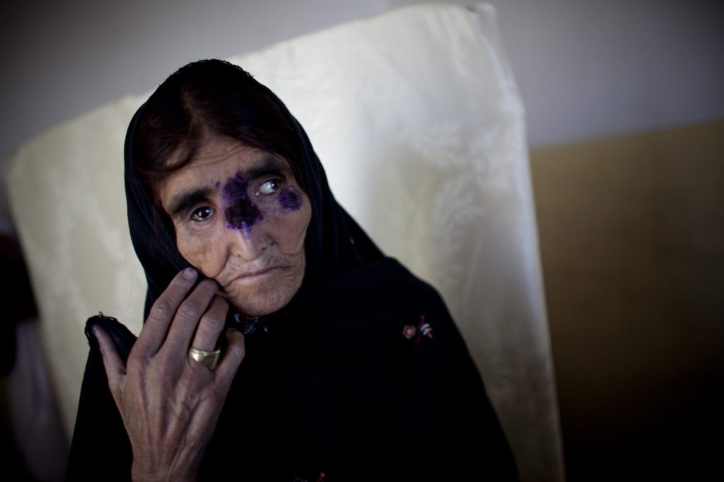 KABUL, AFGHANISTAN - MAY 15: An Afghan recieves treatment for a tropical skin disease at a clinic on May 15, 2010 south of Kabul, Afghanistan. The Afghan capital, Kabul, has one of the highest concentrations of the disfiguring skin disease, Cutaneous leishmaniasis, which is a parasitic disease transmitted by the phlebotomine sand fly. The World Health Organization estimated the number of cases in Kabul jumped from 17,000 in early 2000 to around 65,000 in 2009; the disease is non-lifethreatening and treatable with medication. (Photo by Majid Saeedi/Getty Images)