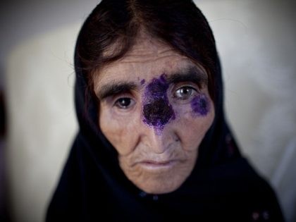 KABUL, AFGHANISTAN - MAY 15: An Afghan recieves treatment for a tropical skin disease at a