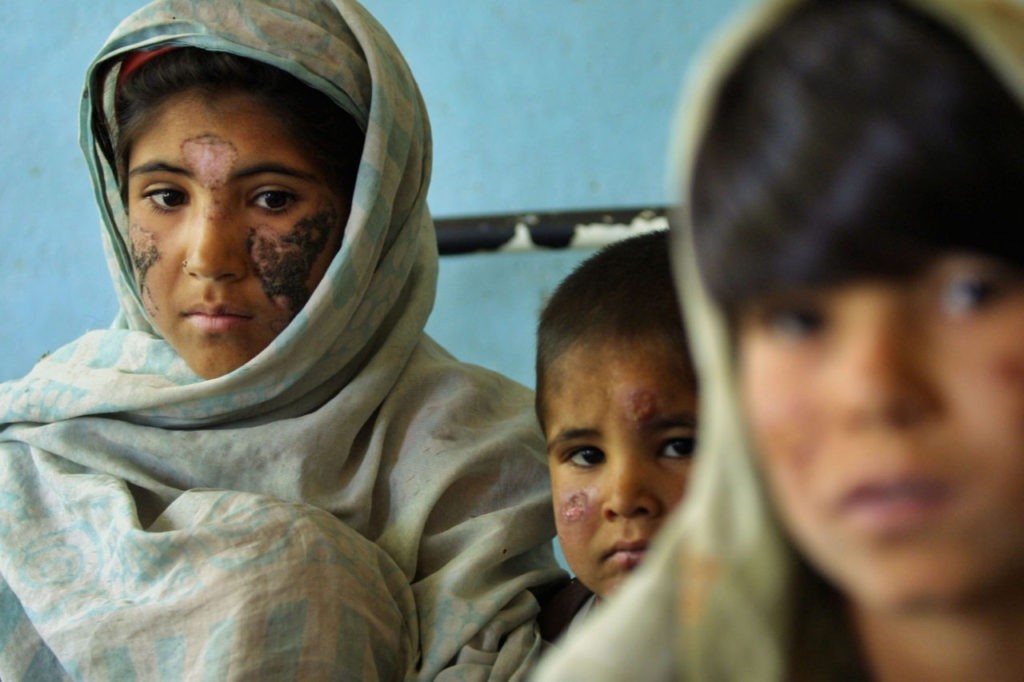405087 04: Children Suffering From Cutaneous Leishmaniasis, A Disfiguring And Disabling Skin Disease, Wait For Treatment At A Hospital May 8, 2002 In Kabul, Afghanistan. Leishmaniasis Is Caused By A Parasite Transmitted By The Sandfly. The Disease Has Affected Approximately 100,000 People In The Capital City This Year. The Disease, Which Begins With A Lesion On The Area That Has Been Bitten, Is Linked To Poor Social Conditions, Especially Lack Of Hygiene And Poor Removal Of Waste Material. The Disease Causes Social Stigmatization, Especially For Girls. A Girl Whose Face Is Scarred May Not Be Considered A Prime Choice For Marriage, Limiting Her Chances For The Future. (Photo By Natalie Behring-Chisholm/Getty Images)
