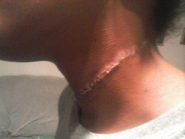 Rope injury on neck