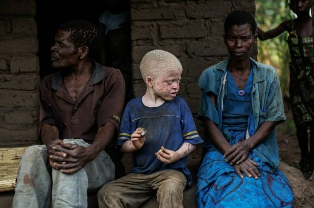 Up to 10,000 Malawians live with albinism, a hereditary condition that causes an absence o