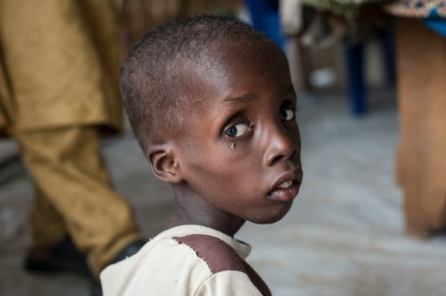 This photo taken on June 30, 2016 shows a boy suffering from severe acute malnutrition sit