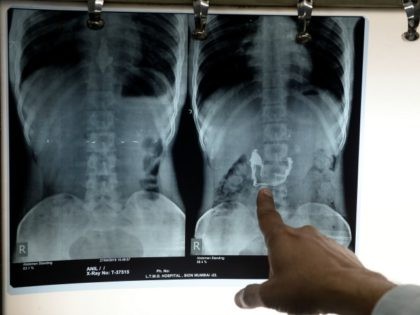Dean of Mumbai's Lokmanya Tilak Medical College and Hospital (Sion hospital) Suleman Merchant inspects x-rays showing a pendant and necklace lodged inside the stomach of Anil Jadhav in Mumbai on May 1, 2015. Jadhav, an alleged thief who swallowed a gold necklace after snatching it from a housewife, has expelled …