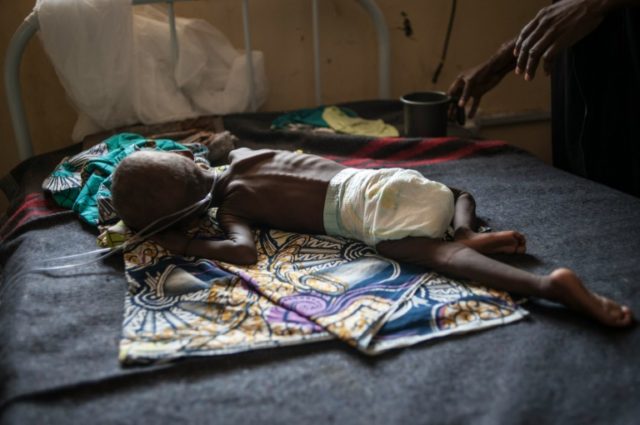 A young child suffering from severe malnutrition is treated at the In-Patient Therapeutic