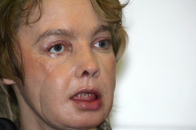 Isabelle Dinoire received the world's first face transplant in 2005