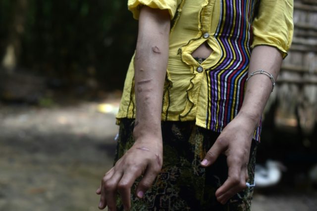 San Kay Khine, a 17-year-old Myanmar child slave shows her scarred arms and twisted finger