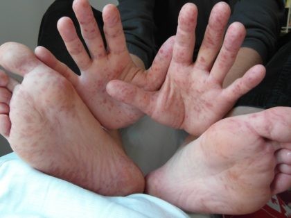 Hand Foot and Mouth disease (Wikimedia Commons)
