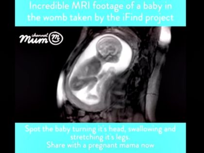 MRI 20 week fetus