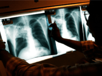 TB xray tuberculosis
