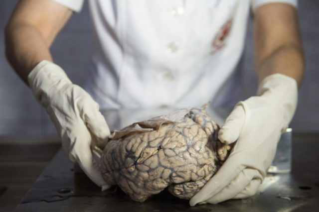 A study found the brains of people with attention deficit hyperactivity disorder found "s