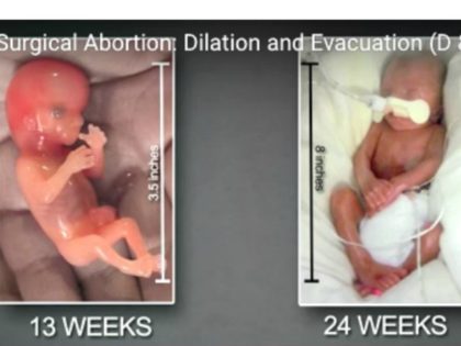 D&E abortion