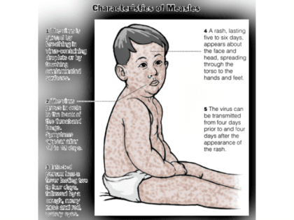 characteristics of measles CDC