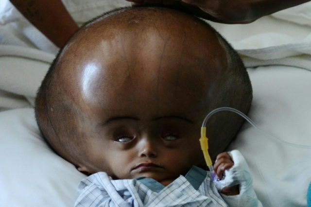 Roona Begum's condition caused her head to swell to a circumference of 94 centimetres (37