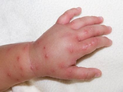 Toddler With Fire Ant Bites and Stings.