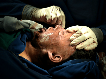 Colombian doctor Alan Gonzalez gets ready to operate on 32-year-old acid attack survivor Angeles Borda in his surgery in Bogota, Colombia on May 30, 2017. Dr. Alan Gonzalez is a Colombian plastic surgeon who provides free operations to women who have been disfigured by acid attacks, through the "Rebuilding Faces" …