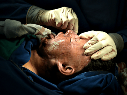 Colombian doctor Alan Gonzalez gets ready to operate on 32-year-old acid attack survivor A