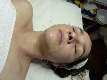 A woman undergoing Accupuncture