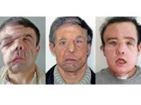 jerome-hamon-france-2-face-transplants-ap Dr. Laurent Lantieri of the Georges-Pompidou Hospital has successfully completed a second face transplant on Jerome Hamon.