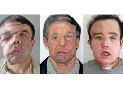 Dr. Laurent Lantieri of the Georges-Pompidou Hospital has successfully completed a second face transplant on Jerome Hamon.