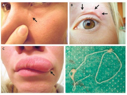 Woman Documents Moving Lump on Face with Selfies, Doctors Find Parasite
