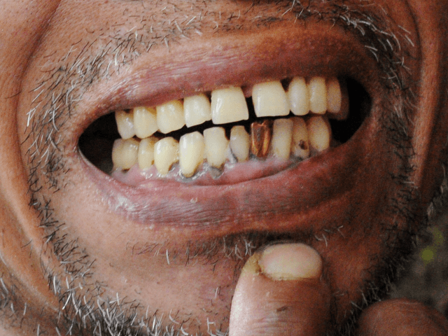 Man in Paris No-Go Zone Has Gold Teeth Ripped Out