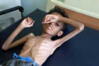 Ten-year old Ghazi Ali bin Ali suffers from severe malnutrition as the war in Yemen pushes millions to the brink of famine