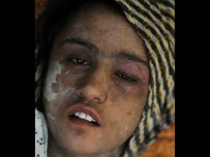 Fifteen-year-old Afghan child bride Sahar Gul recovers in a Kabul hospital after her husband's family tortured her. Some 15 million girls under 18 marry each year, often under duress, ending their schooling and putting them at risk for domestic violence. Still, girls' rights have advanced significantly in the past 25 …