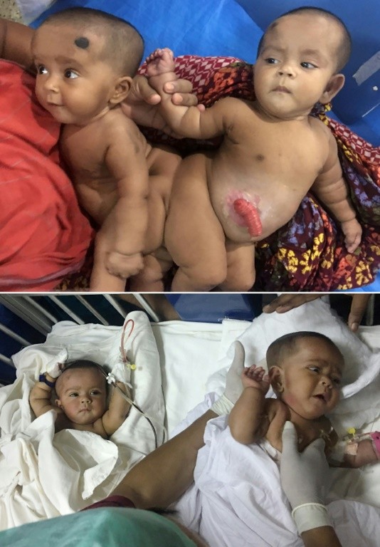 Walking, talking and separated: Bangladesh conjoined twins go home