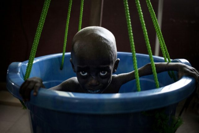 The battle to save Central African Republic's starving children