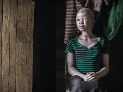 Catherine Amidu , a 12-year-old Malawian albino girl, sits in her home, in the traditional authority area of Nkole, Machinga district, on April 17, 2015. Six albinos have been killed in the poor southern African nation since December, according to the Association of Persons with Albinism in Malawi. AFP PHOTO …