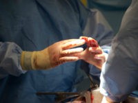 surgeon's-bloody-hands-ap FILE - In this Tuesday, June 28, 2016 file photo, surgeons discuss a procedure during a surgery in Washington. In a study released Wednesday, Feb. 15, 2017, complications including infections and surgical incision problems were most common in patients whose surgeons had received lots of earlier complaints about their behavior. …