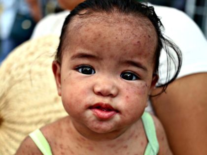 A Filipino child with measles. Photo- Alejandro Ernestopicture alliance via Getty Images