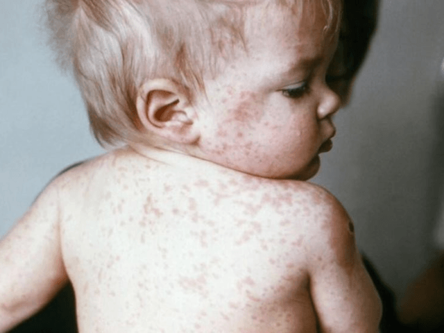 Should You Get a Measles Booster Shot? Here's What Experts Say