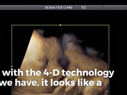 4D Ultrasound of Baby