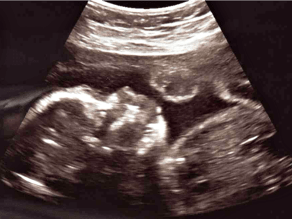 ultrasound-2nd-3d-trimester-1