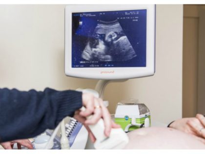 ultrasound fetal heartbeat